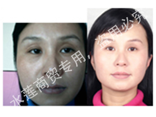 混合斑治疗前后