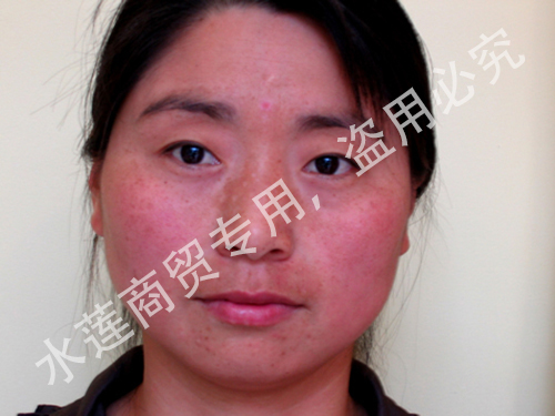 黄褐斑治疗前