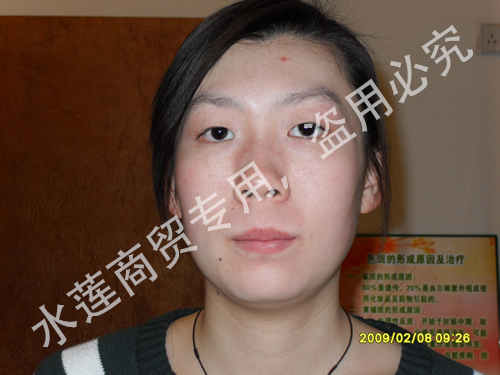 雀斑治疗后