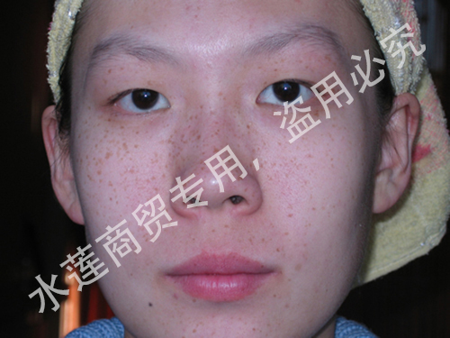 雀斑治疗前