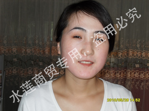 雀斑治疗后