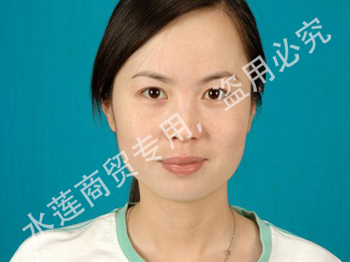 雀斑治疗后