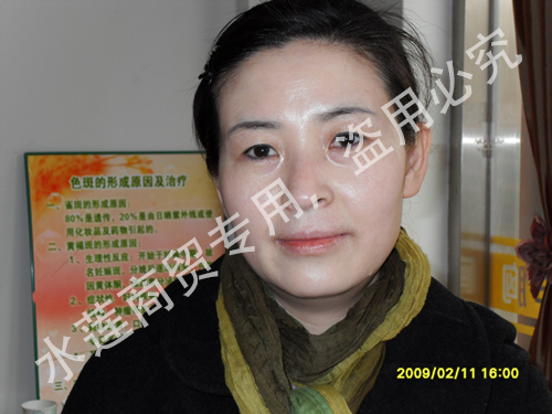 雀斑治疗后