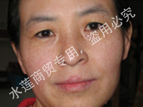 雀斑治疗前