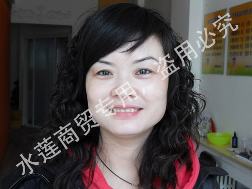 雀斑治疗后