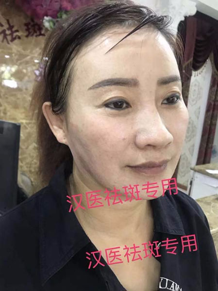 雀斑治疗后