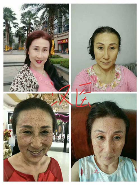 治疗雀斑全程变化