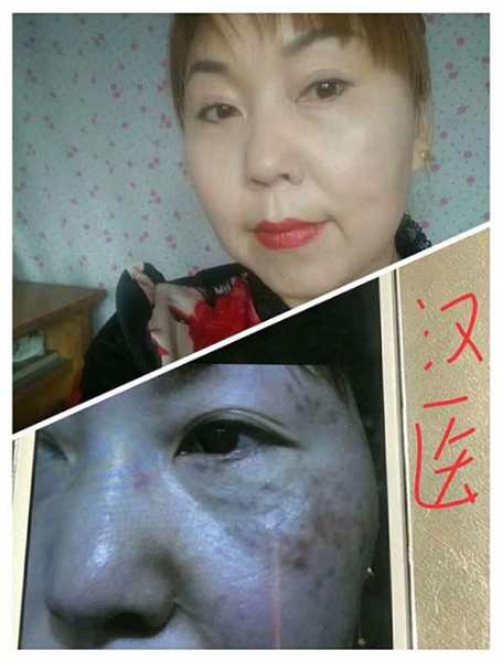 祛斑前后对比