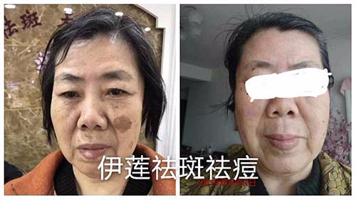 黄褐斑治疗前后