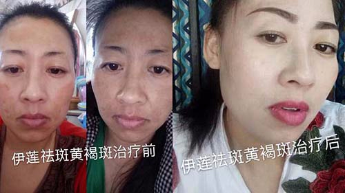 黄褐斑治疗前后